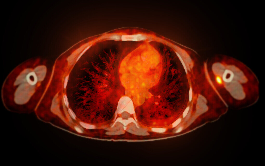 Normal chest, CT-PET scan