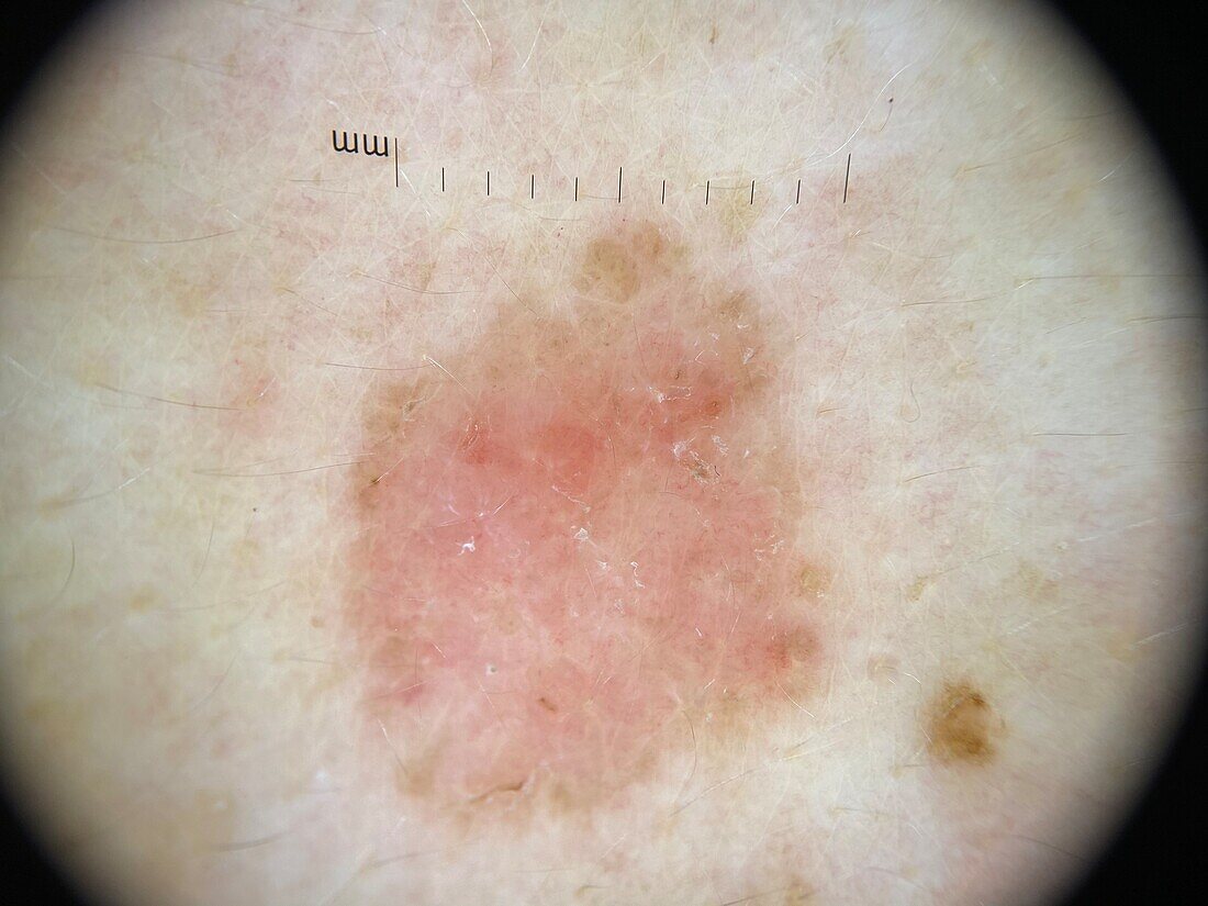 Basal cell carcinoma superficial, dermoscopy