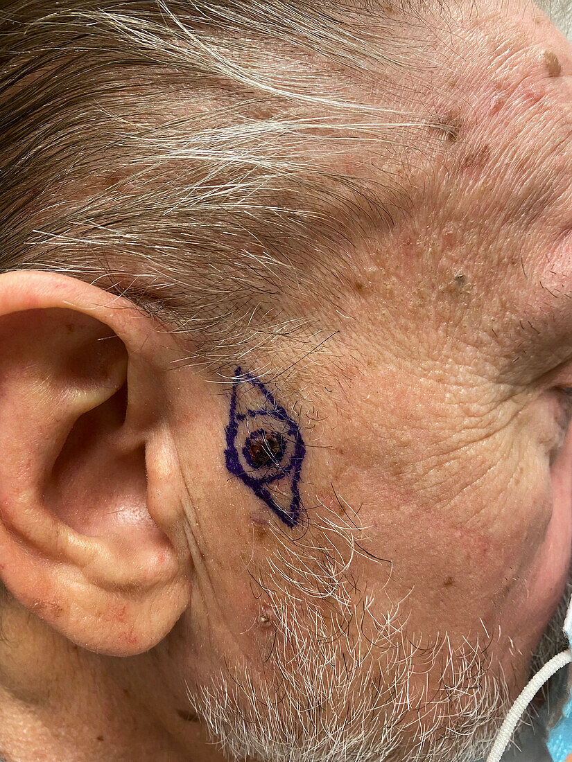 Basal cell carcinoma marked for excision