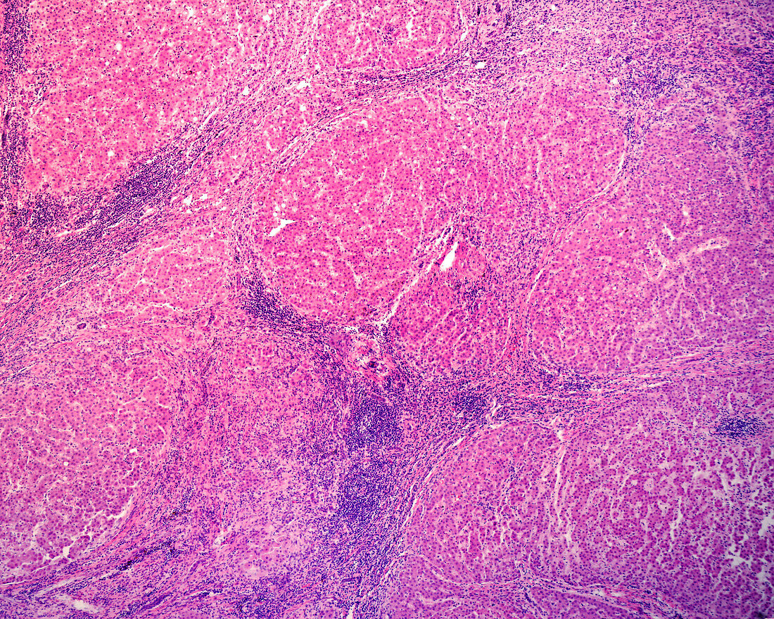 Cirrhosis, light micrograph