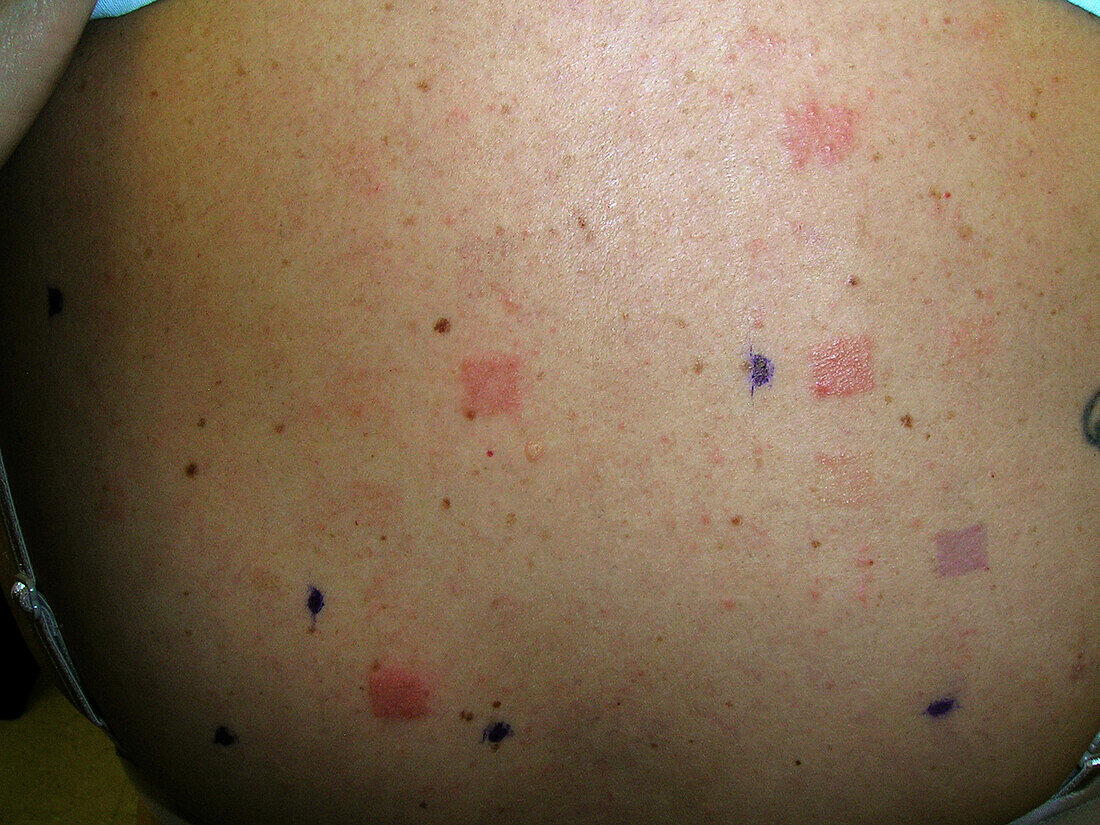 Positive patch test