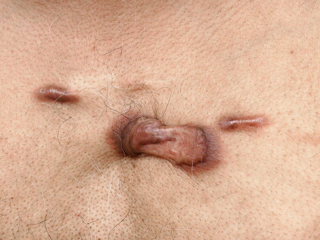 Keloid scars