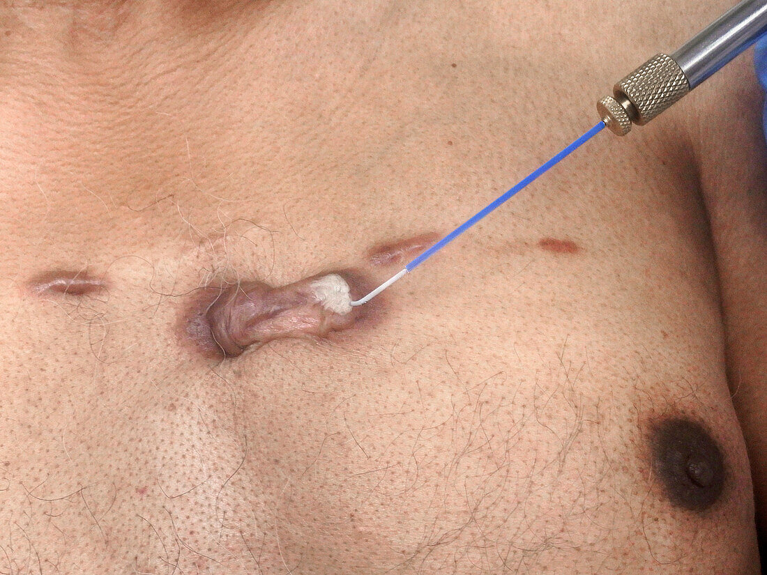 Cryosurgery of keloid scars