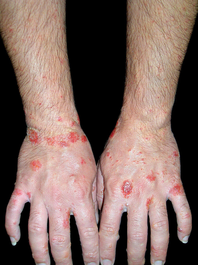 Dyshidrotic and nummular eczema