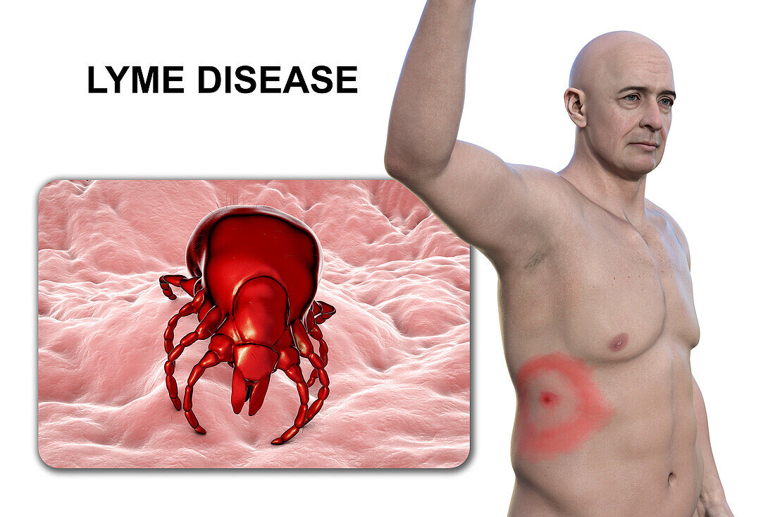 Lyme disease, illustration