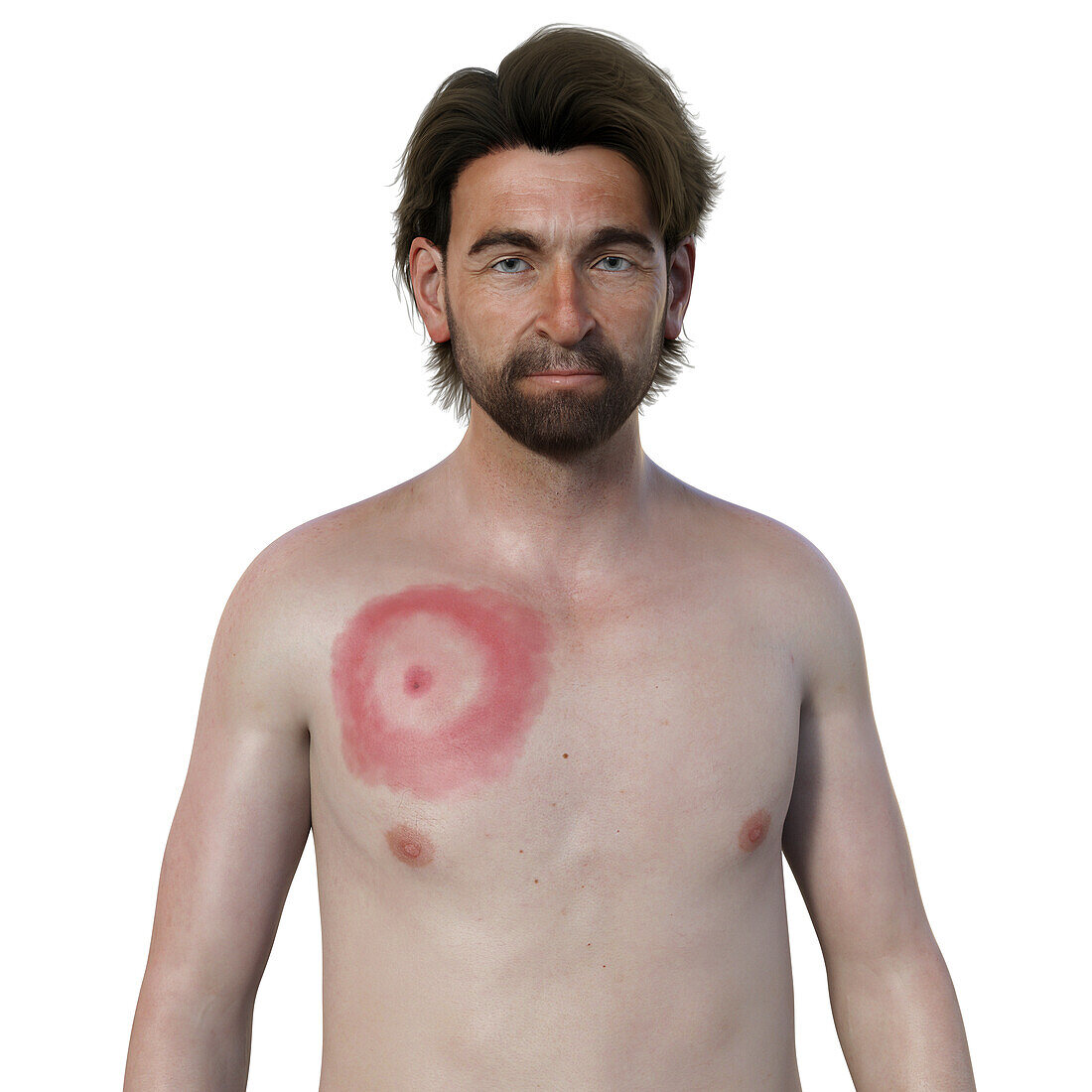 Man with erythema migrans from Lyme disease, illustration