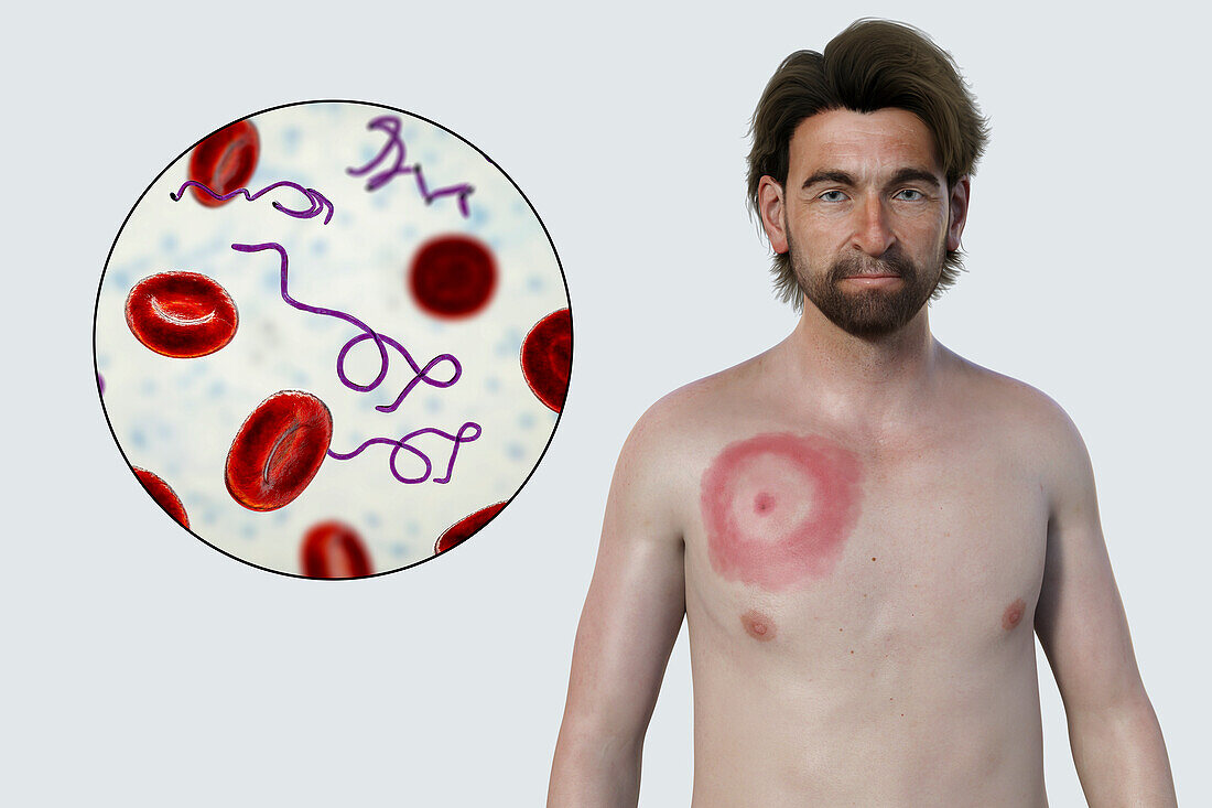 Man with erythema migrans from Lyme disease, illustration