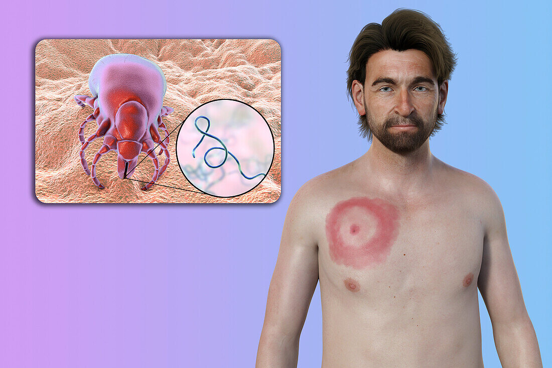 Man with erythema migrans from Lyme disease, illustration