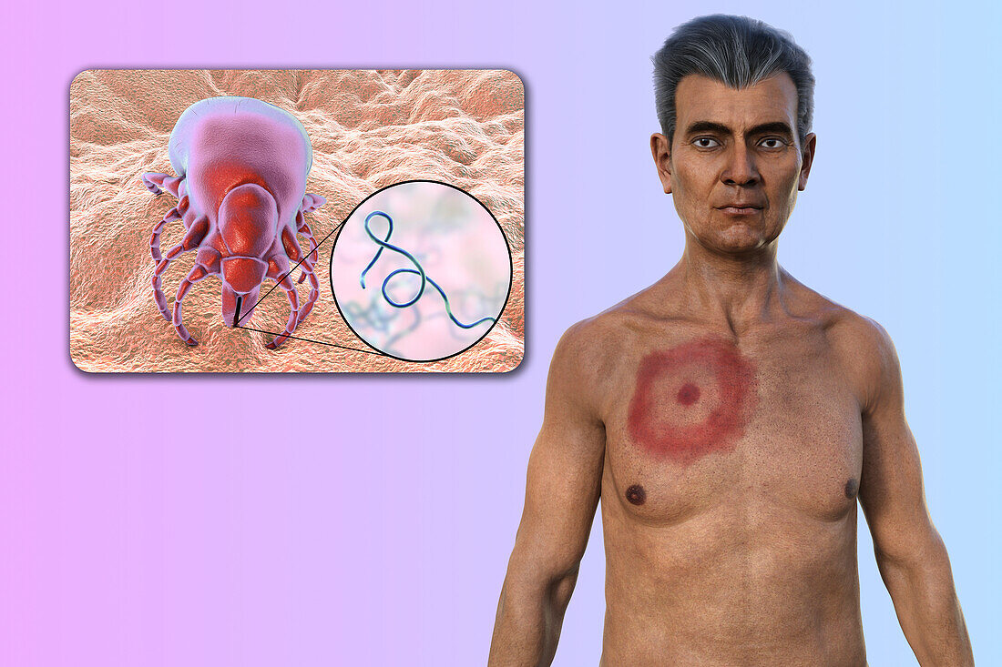 Man with erythema migrans from Lyme disease, illustration