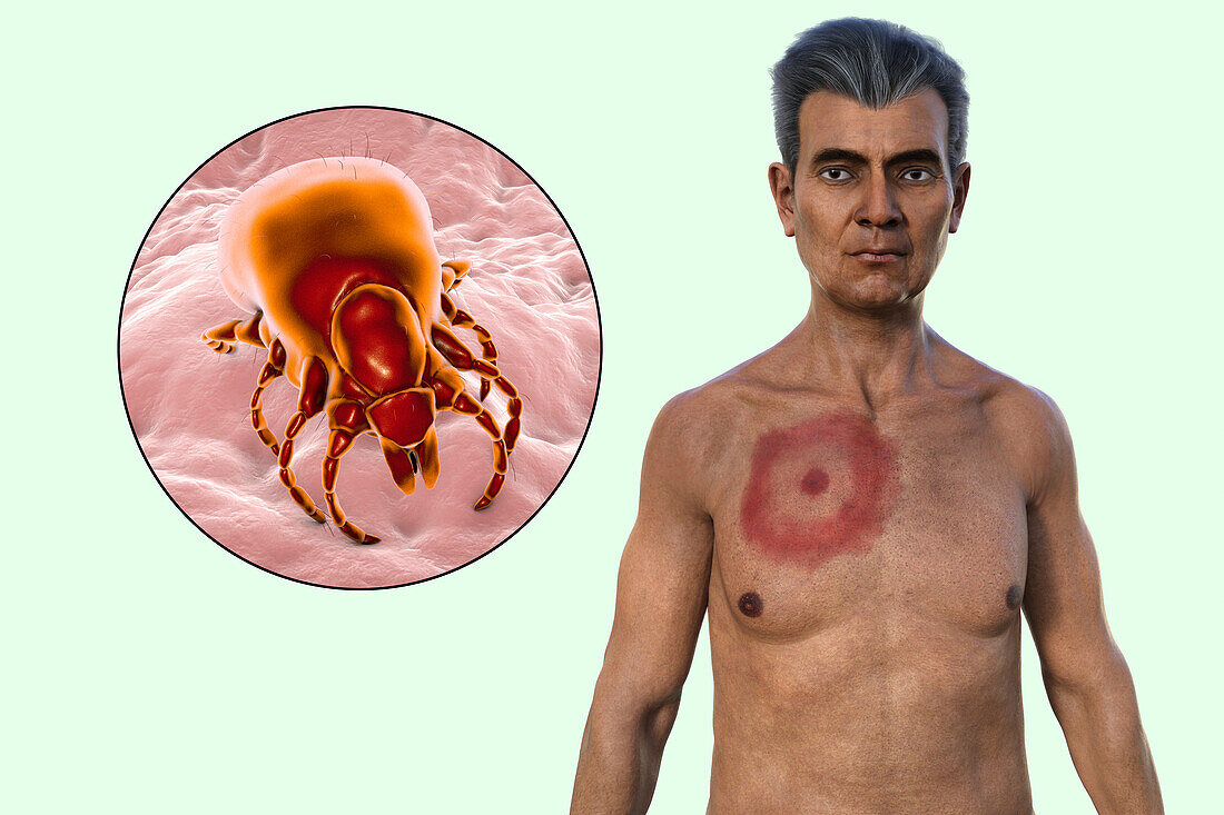 Man with erythema migrans from Lyme disease, illustration