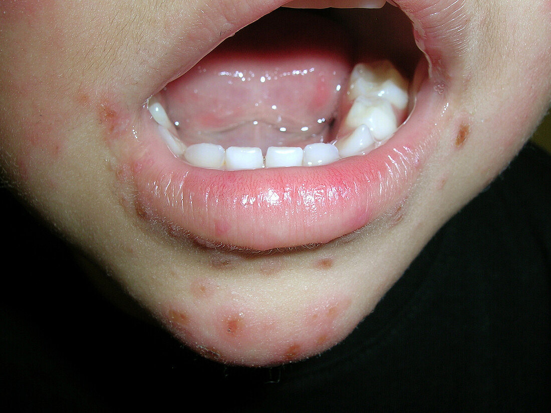 Hand foot and mouth disease