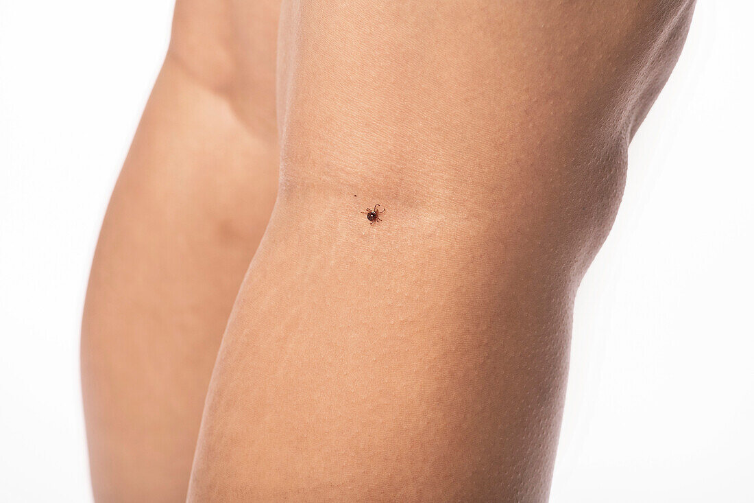 Lone star tick on a person's leg