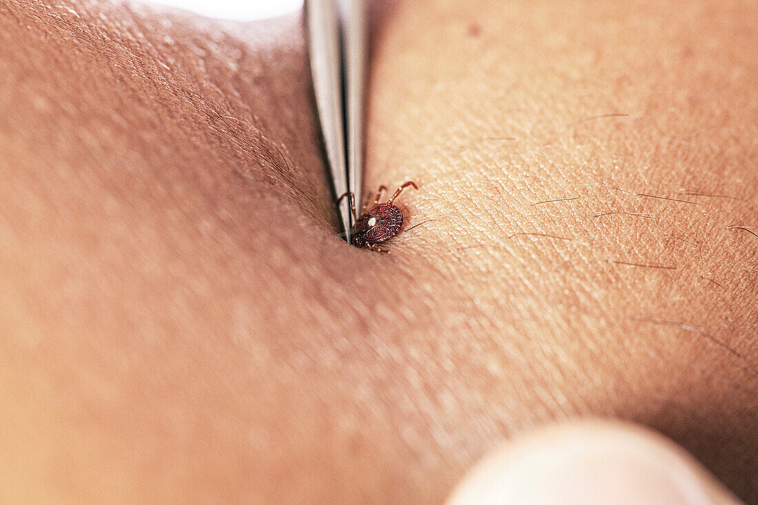 Lone star tick being removed from skin with tweezers