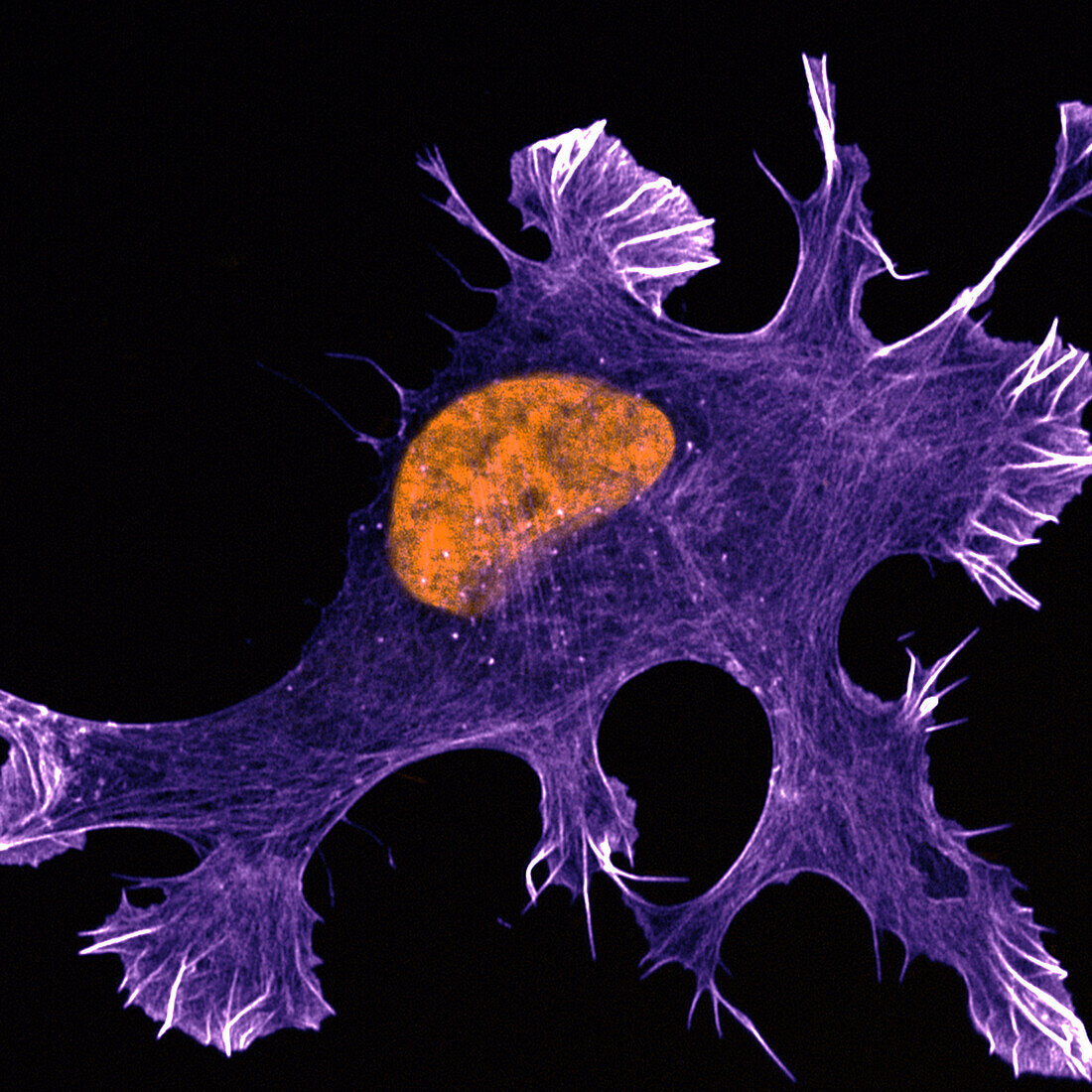 Ewing sarcoma cancer cell, confocal light micrograph