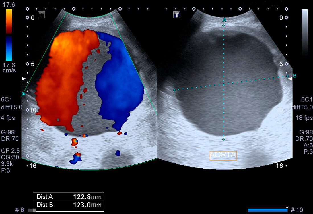 Abdominal aortic aneurism, ultrasound scan