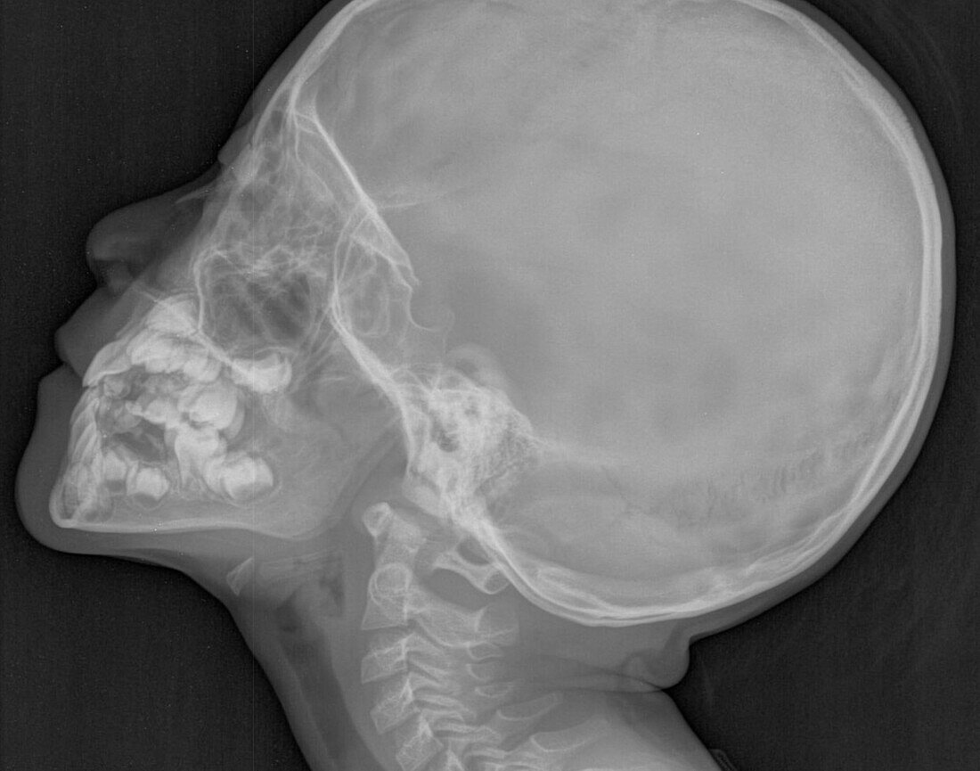 Enlarged adenoids, X-ray