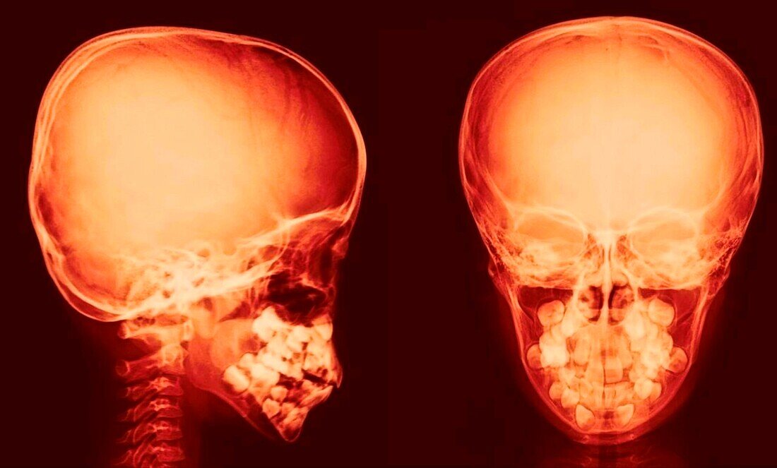 Normal skull, X-ray