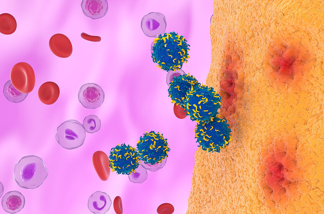 CAR-T cell therapy in rheumatoid arthritis, illustration