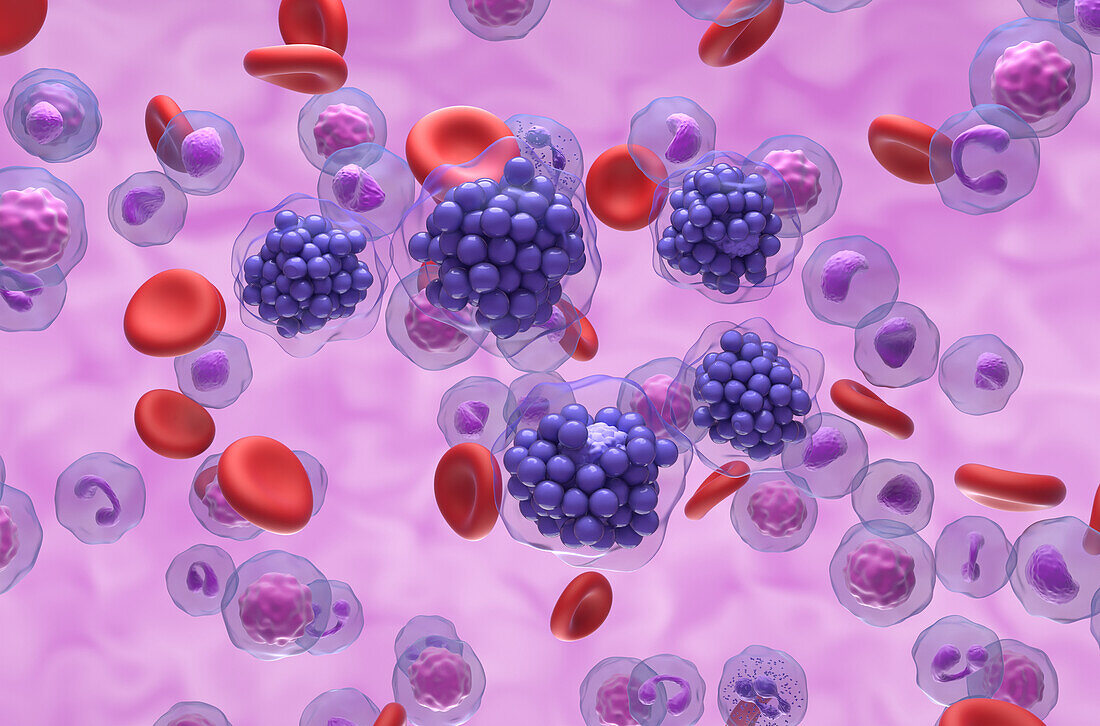 Diffuse large B-cell lymphoma, illustration