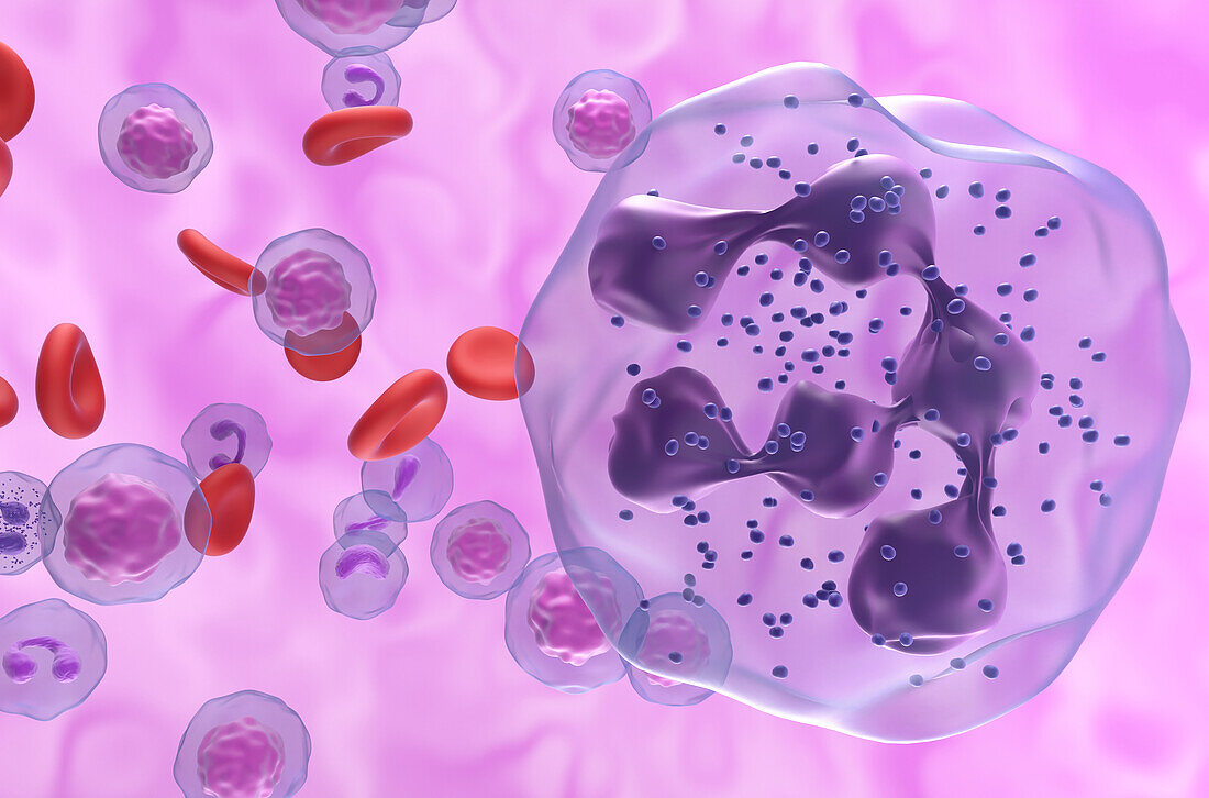 Hyper-segmented neutrophil in WHIM syndrome, illustration