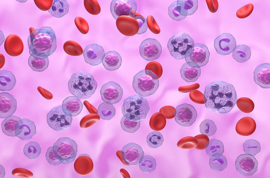 Hyper-segmented neutrophils in WHIM syndrome, illustration