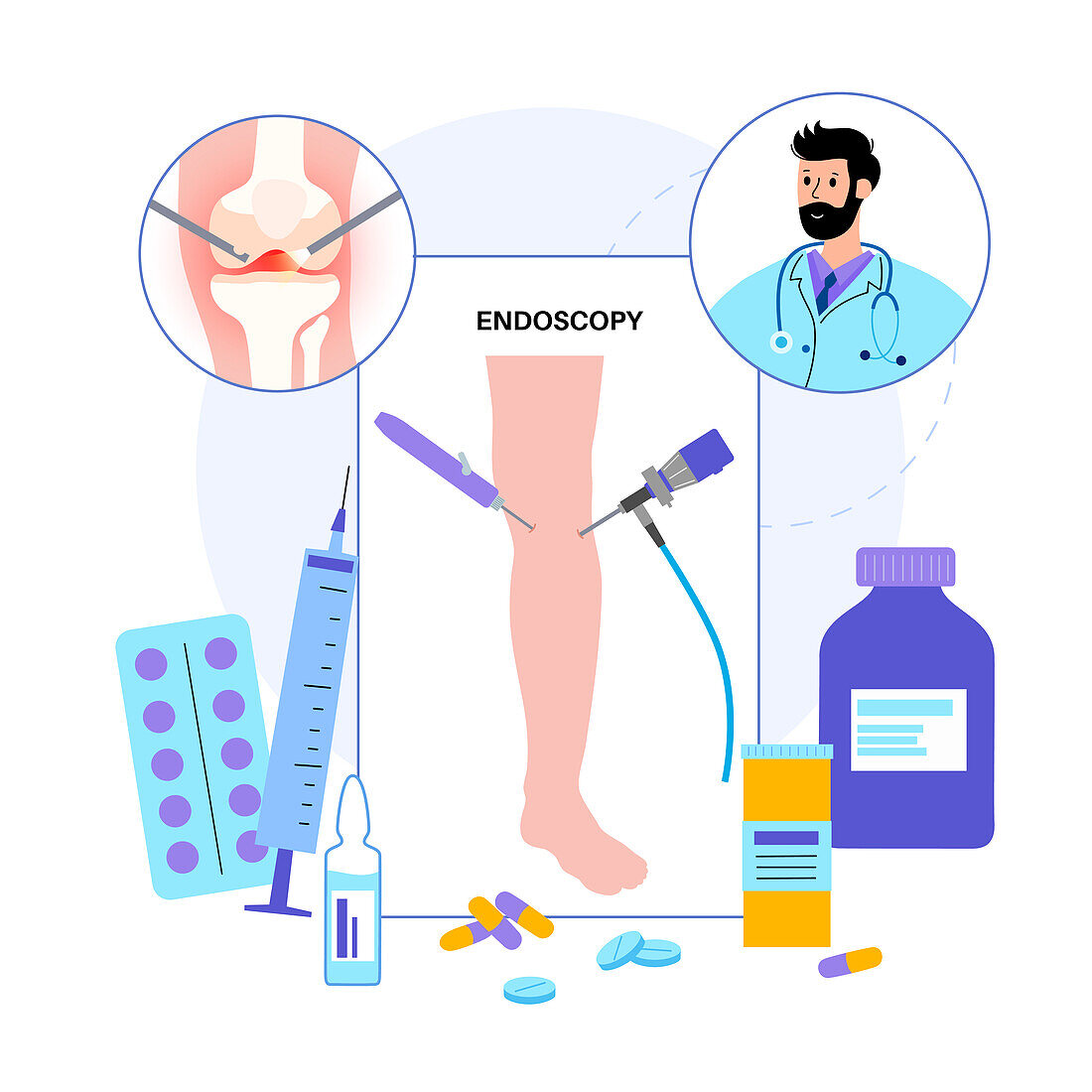 Knee joint arthroscopy, illustration