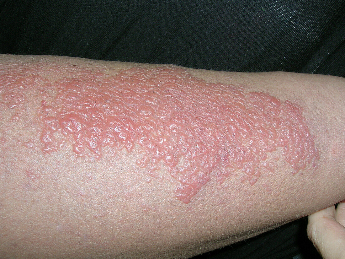 Lupus erythematosus