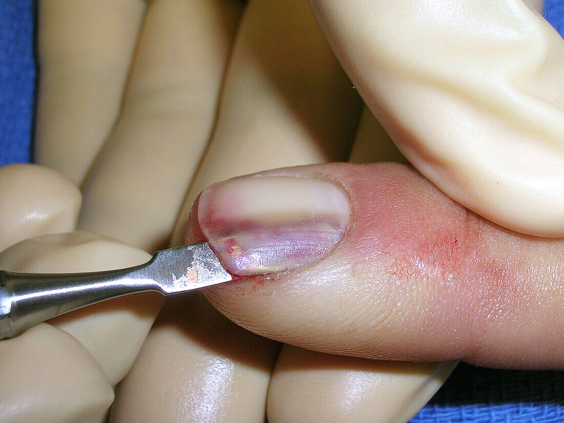 Biopsy of discoloured nail