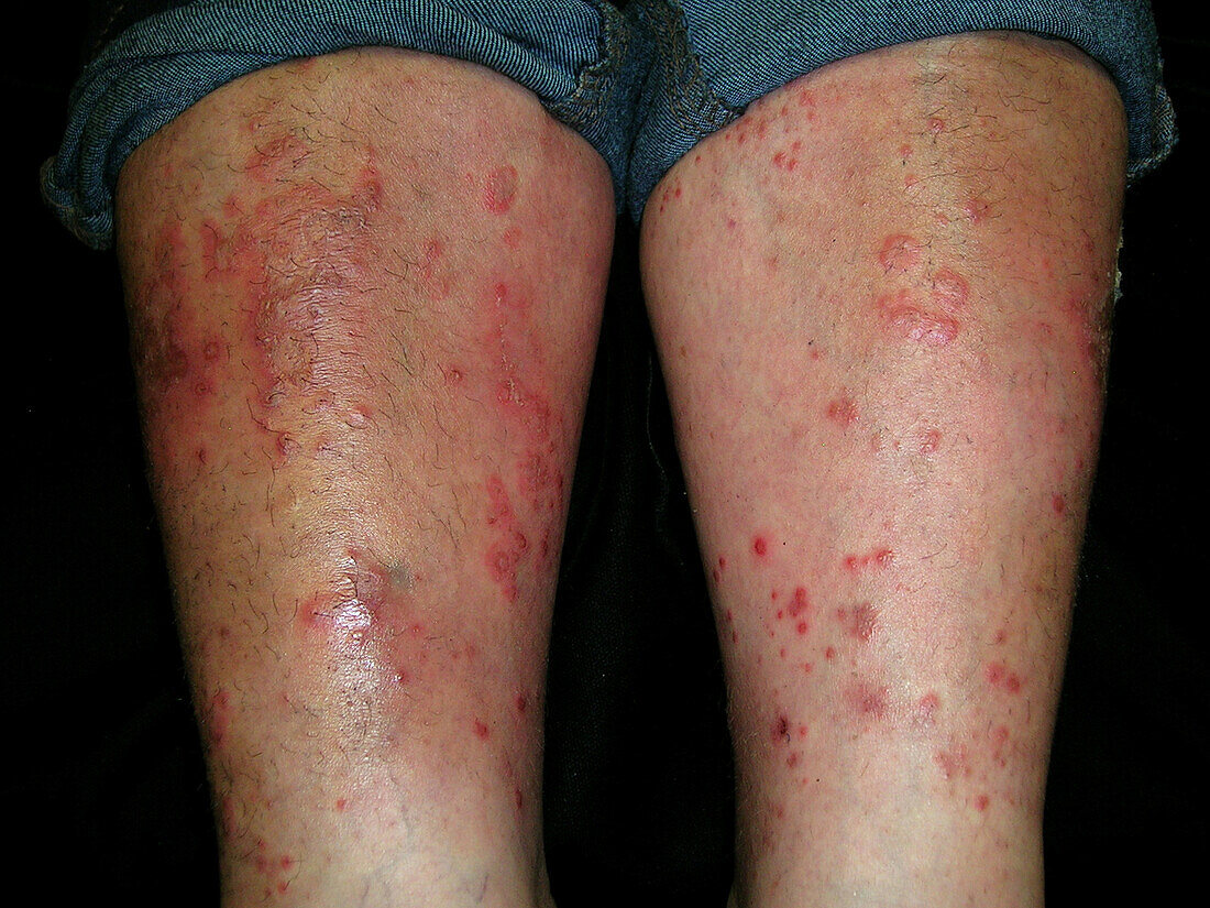 Pustular psoriasis