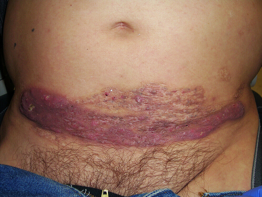 Pyoderma gangrenosum