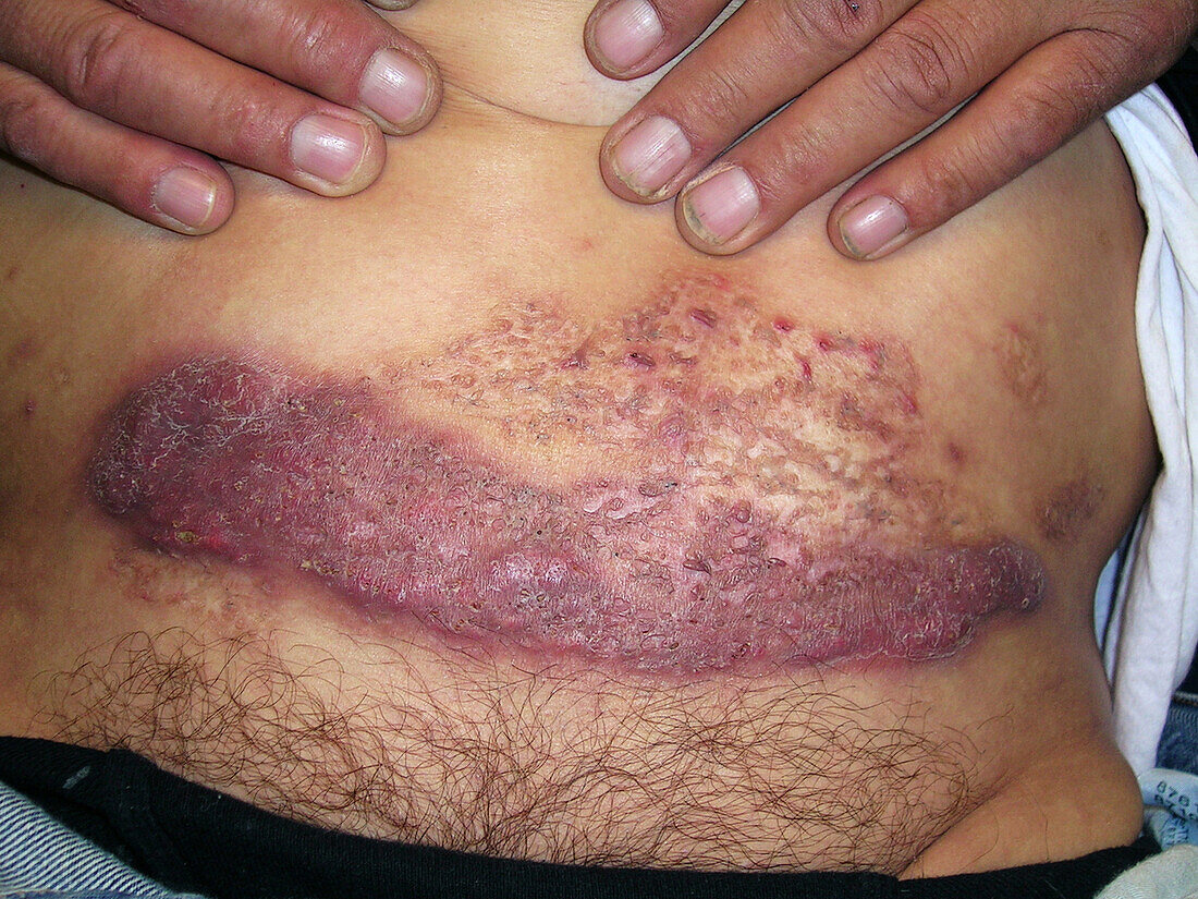 Pyoderma gangrenosum