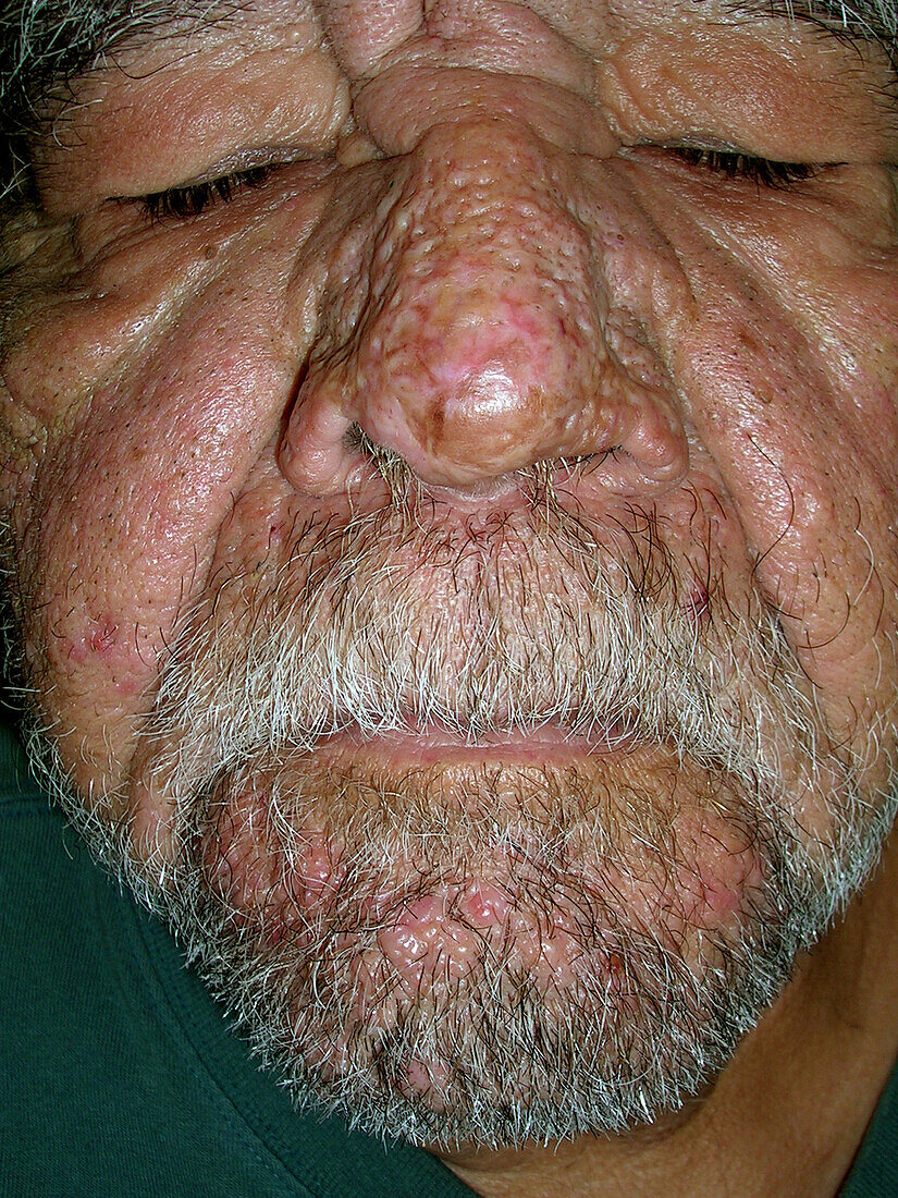 Rhinophyma after surgeries