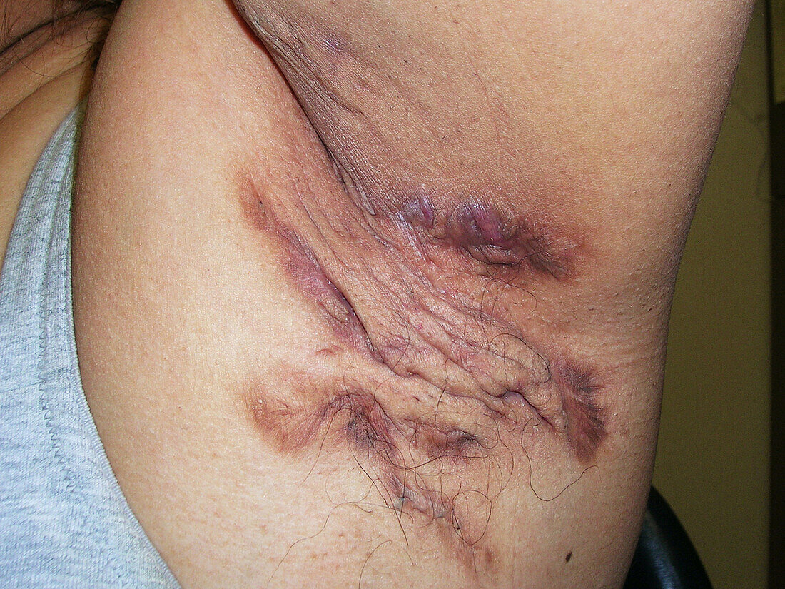 Hidradenitis suppurativa treated with infliximab