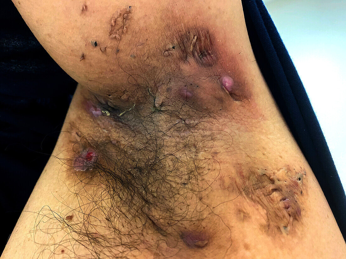 Hidradenitis suppurativa treated with infliximab