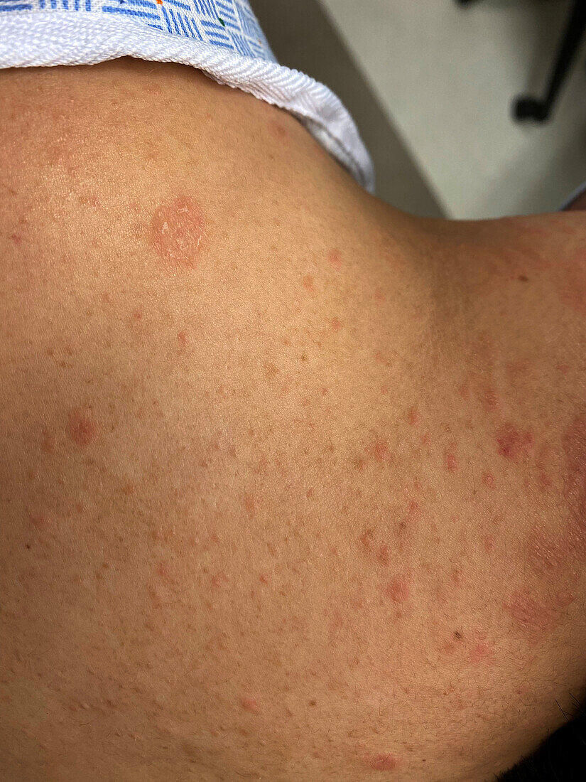 Pityriasis rosea rash