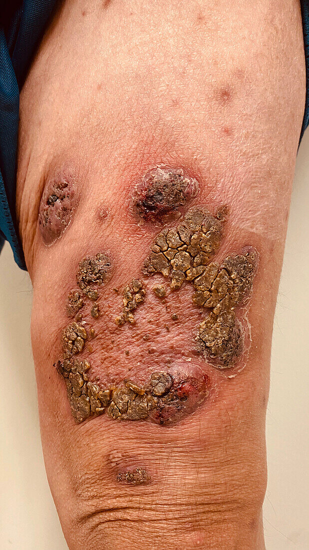 Pyoderma gangrenosum