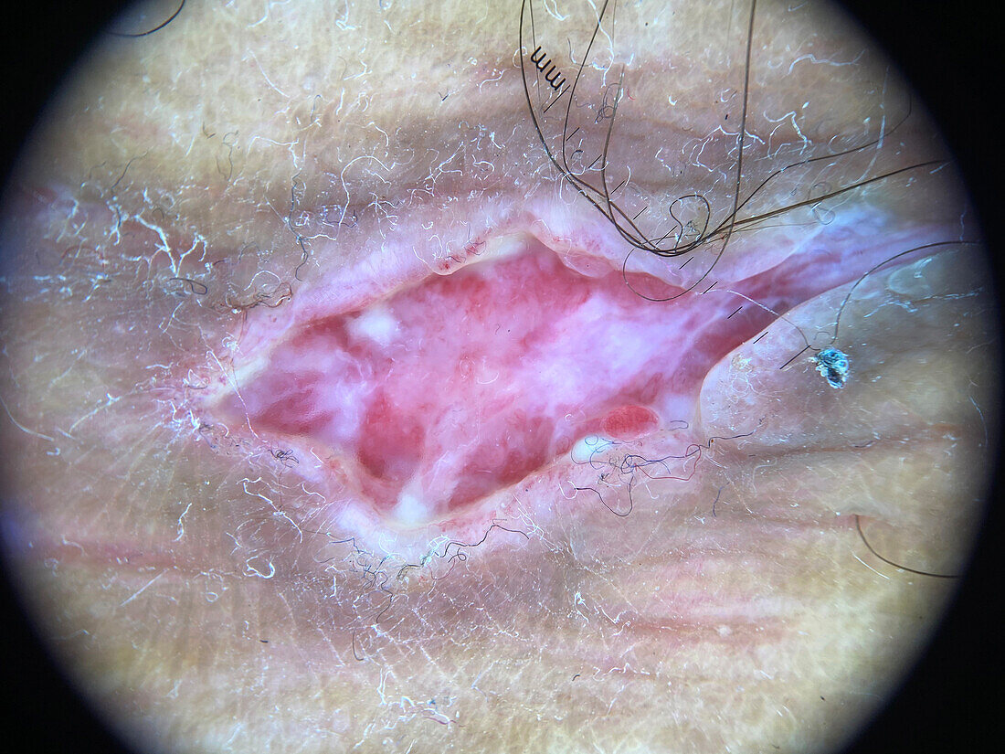 Pyoderma gangrenosum, dermoscopy