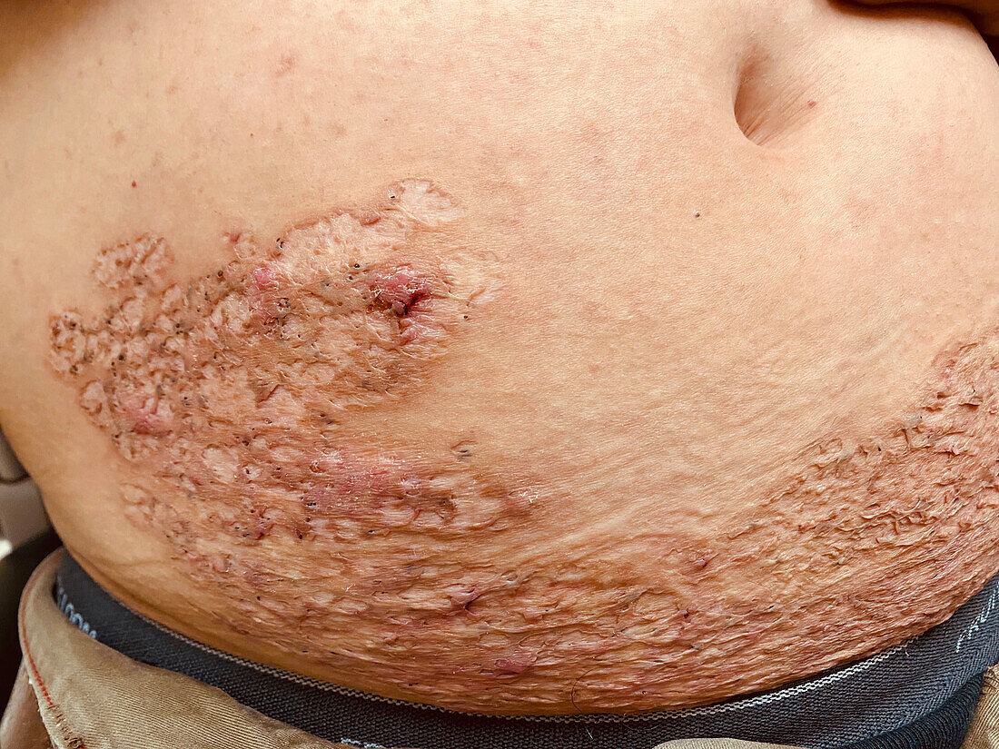 Pyoderma gangrenosum