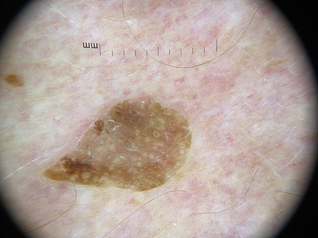 Seborrheic keratosis, dermoscopy