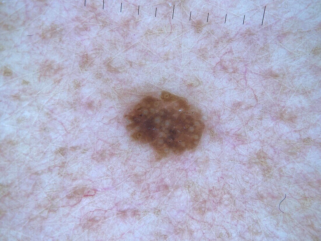 Seborrheic keratosis, dermoscopy