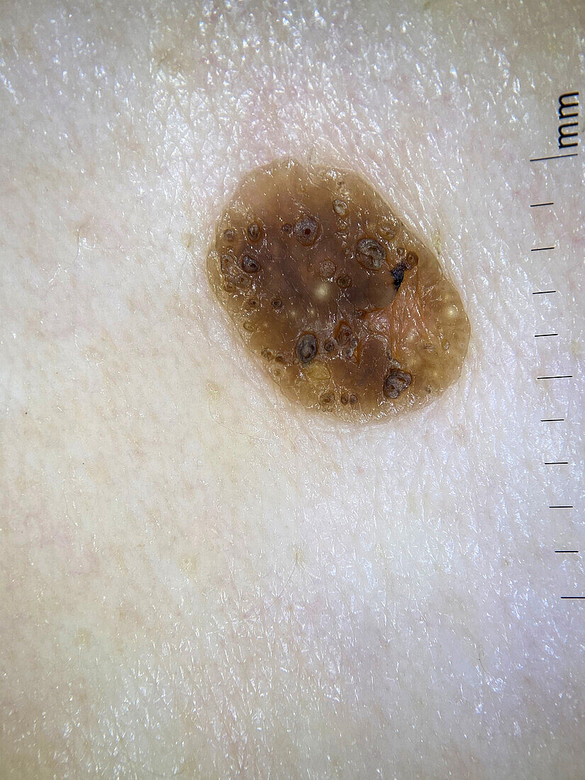 Seborrheic keratosis, dermoscopy