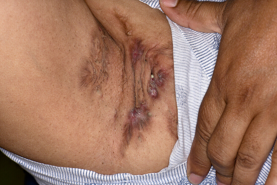 Hidradenitis suppurativa