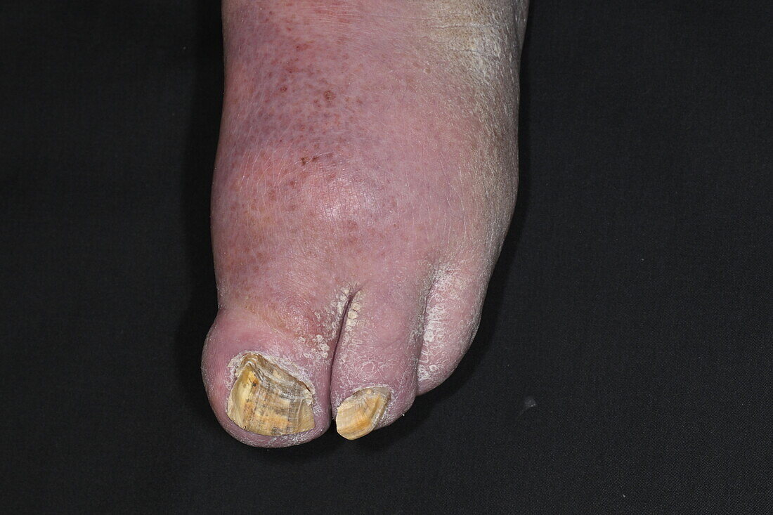 Congenital absence of toes in male patient