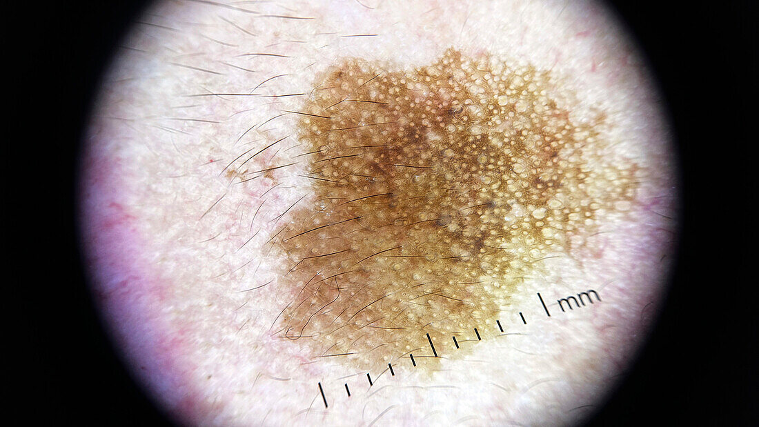 Seborrheic keratosis, dermoscopy