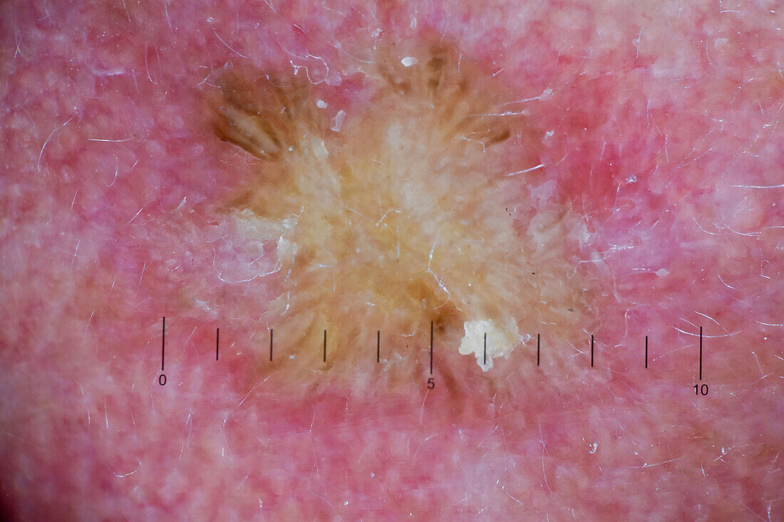 Solar keratosis on a man's scalp