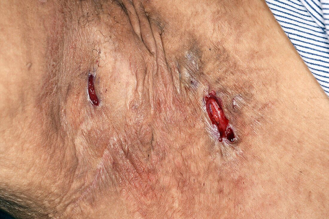 Hidradenitis suppurativa treated with deroofing