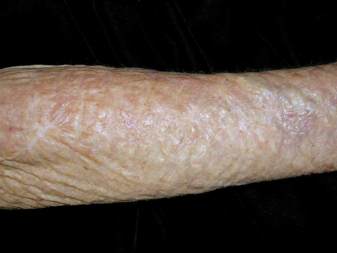 Treatment of actinic keratosis