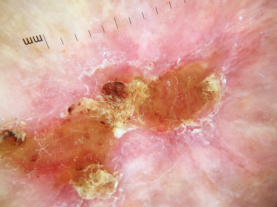 Treatment of actinic keratosis, dermoscopy