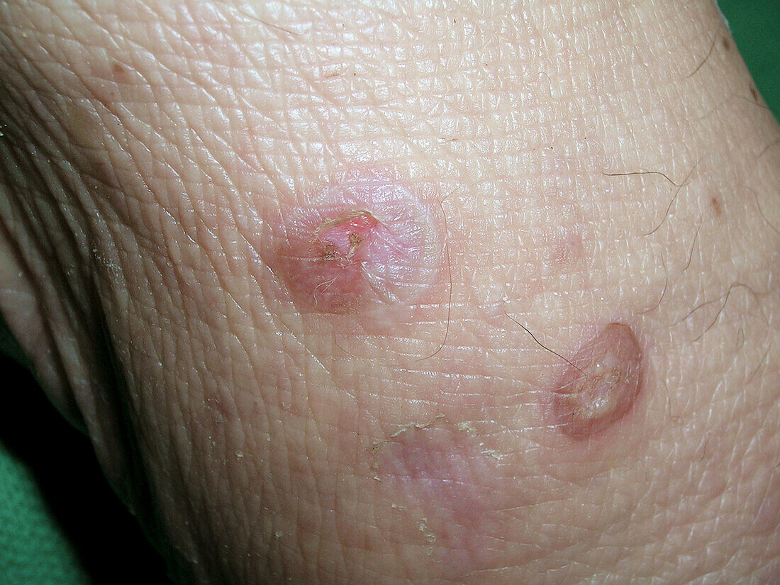 Bullous pemphigoid