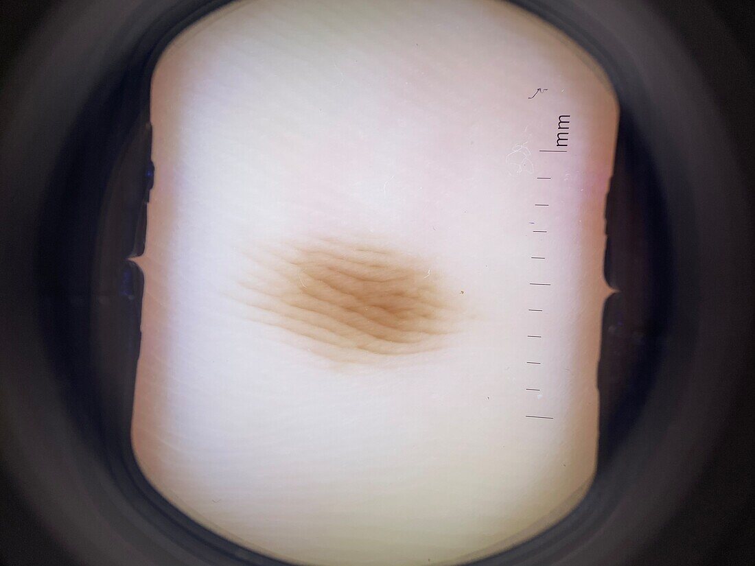 Parallel furrow pattern in mole, dermoscopy